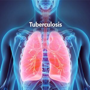 Tuberculosis-TB